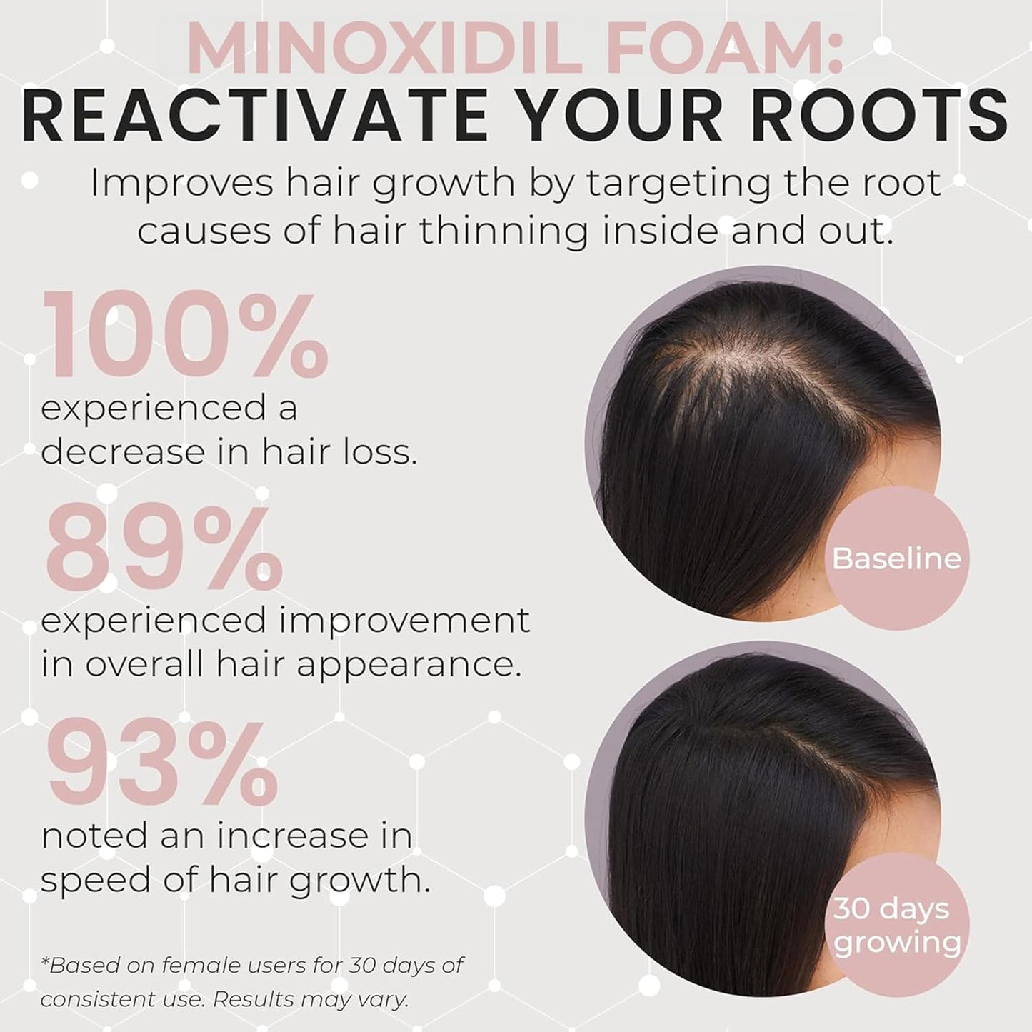 Minoxidil for Women | 5% Minoxidil For Women Hair Growth | Hair Regrowth Treatment | Unscented Topical Foam | Dermatologist Recommended | Clinically Proven Formula | 3 Month Supply