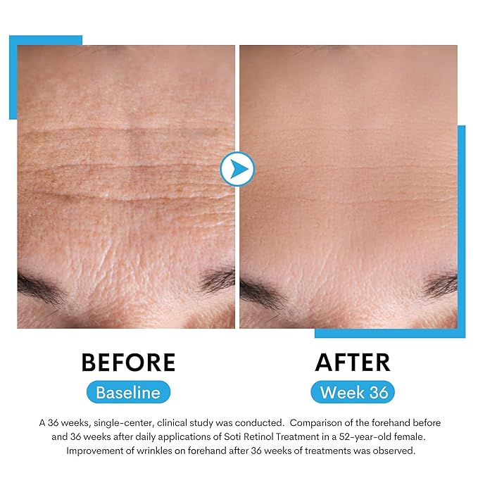 Soti 2.5% Retinol Serum, Reduces Wrinkles, Age Spots, Post-Acne Marks. Stimulates Collagen, Firm Skin, Anti Aging with Hyaluronic Acid, Niacinamide (30ml)