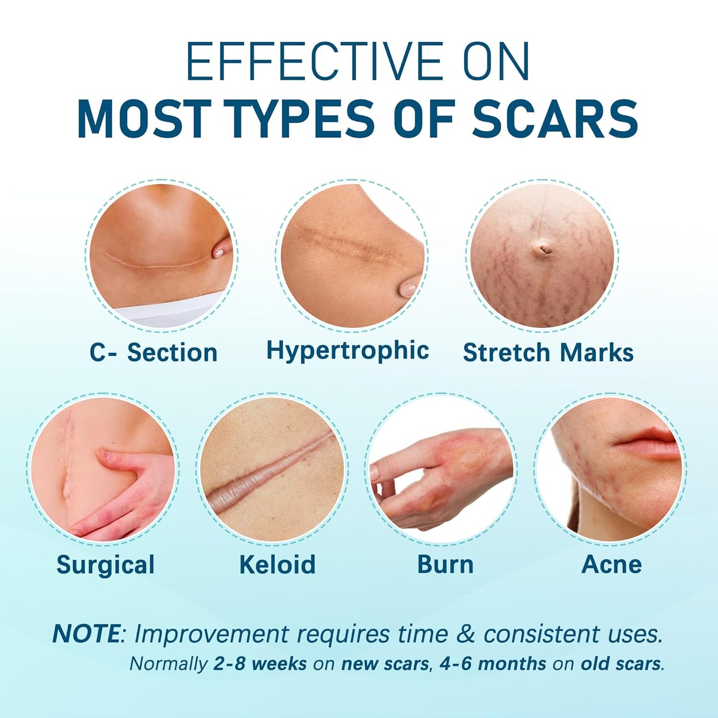 Silicone Scar Sheets, 10pcs, Silicone Tape for Scar Treatment, Reusable Scar Strips for Surgical, C-Section, Keloid Bump, Stretch Marks, Burn, Acne Scar Removal, Each 1.5” x 6”