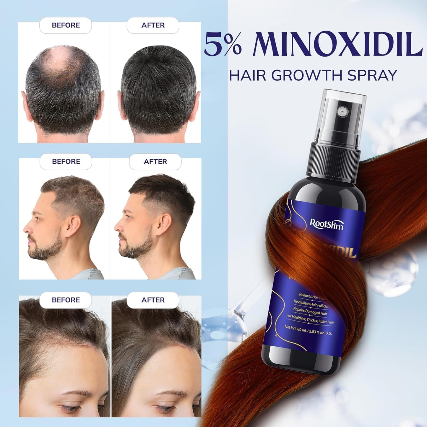 5% Minoxidil Hair Growth for Men and Women: Extra Strength Minoxidil Hair Loss Treatment Serum with Rosemary for Faster Stronger Thicker Hair Growth 2 FL OZ