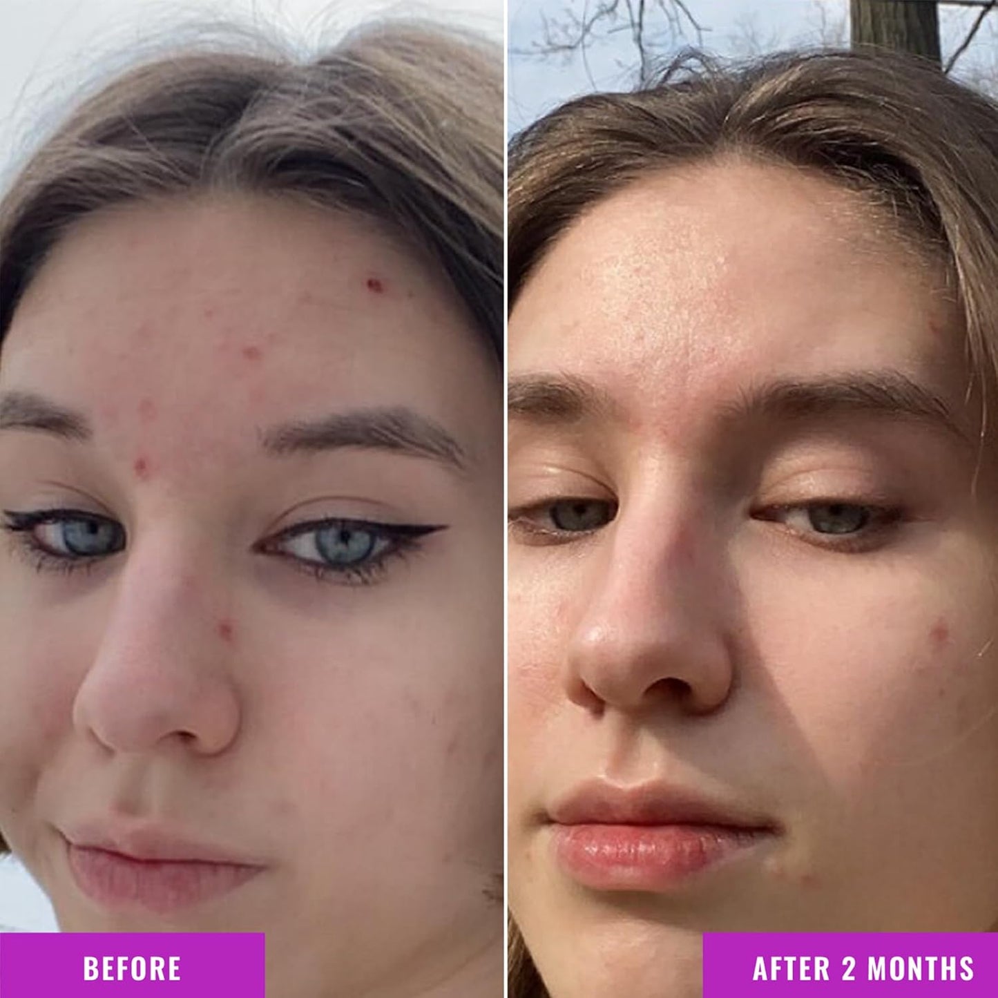 Good Molecules Niacinamide Serum - 10% Niacinamide to Target Acne, Nourishment, and Skin Tone - Ultra Hydrating Serum and Brightening Skin Care for Face