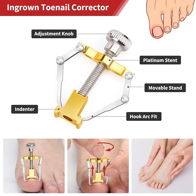 Segbeauty 10pcs Ingrown Toenail Tool, Nail Clippers Pedicure Knife Set Ingrown Toenail Removal Kit, High Manganese Steel Ingrown Toenail Treat-Ment Corrector Tool Blade for Cuticle Remove