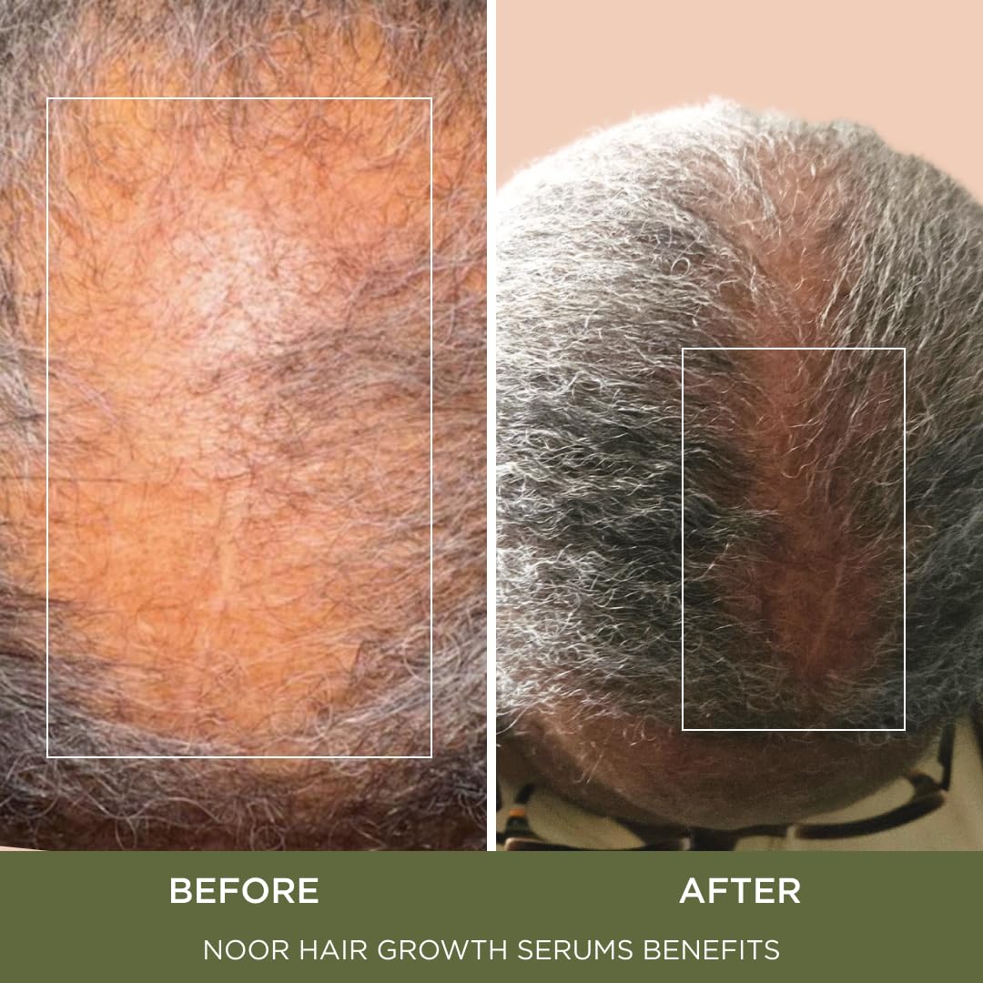 NOOR HAIR Growth Super Hair Serum for Frizzy and Damaged Hair, Prevent Hair Loss & Thinning, Hair Treatment Serum for Women