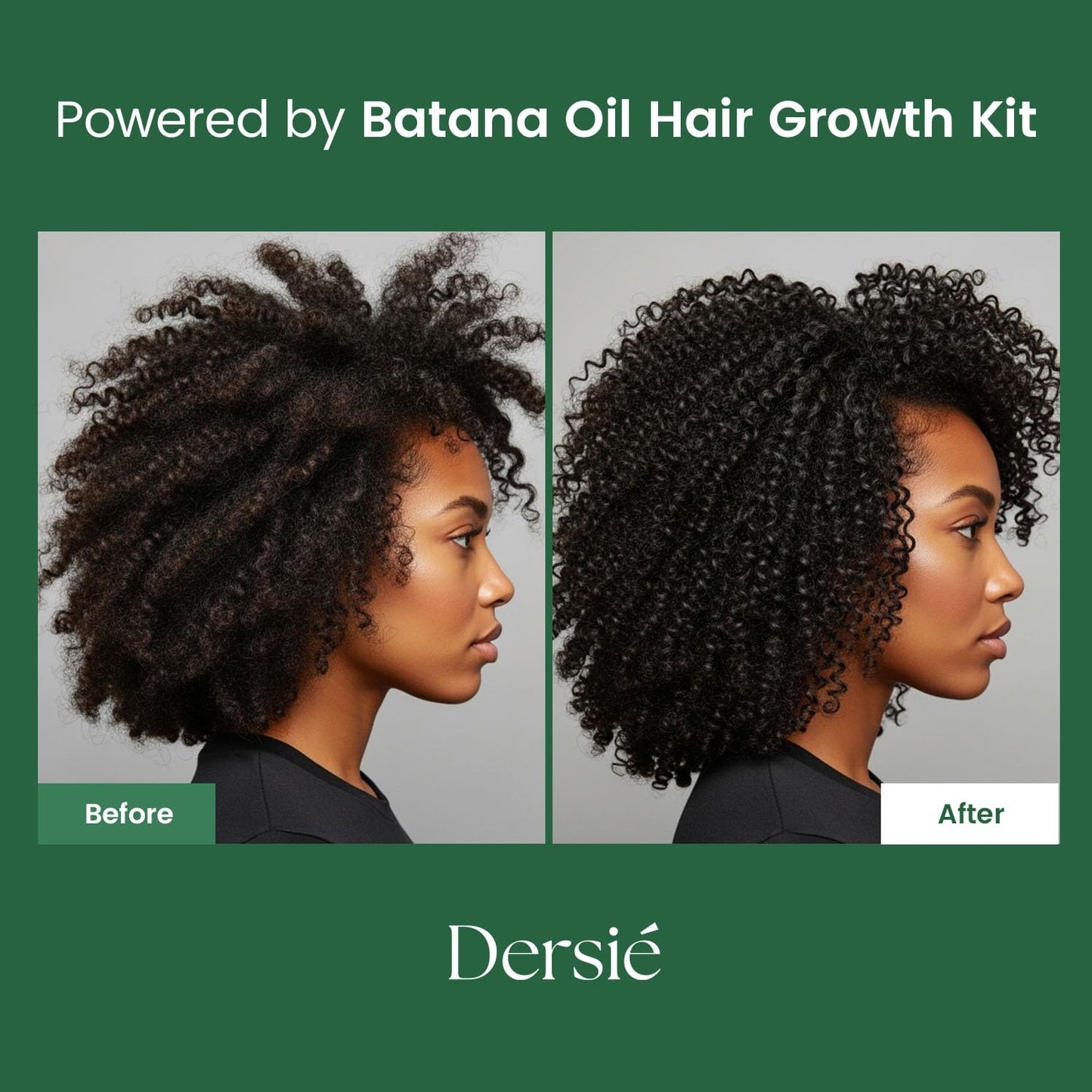 Dersie Batana Oil for Hair Growth Kit – 100% Pure Batana Oil & Batana Shampoo Sourced from Honduras – Promotes Hair Growth & Nourishes Scalp – For Hair Loss, Thinning Hair, Dry, Damaged & Curly Hair