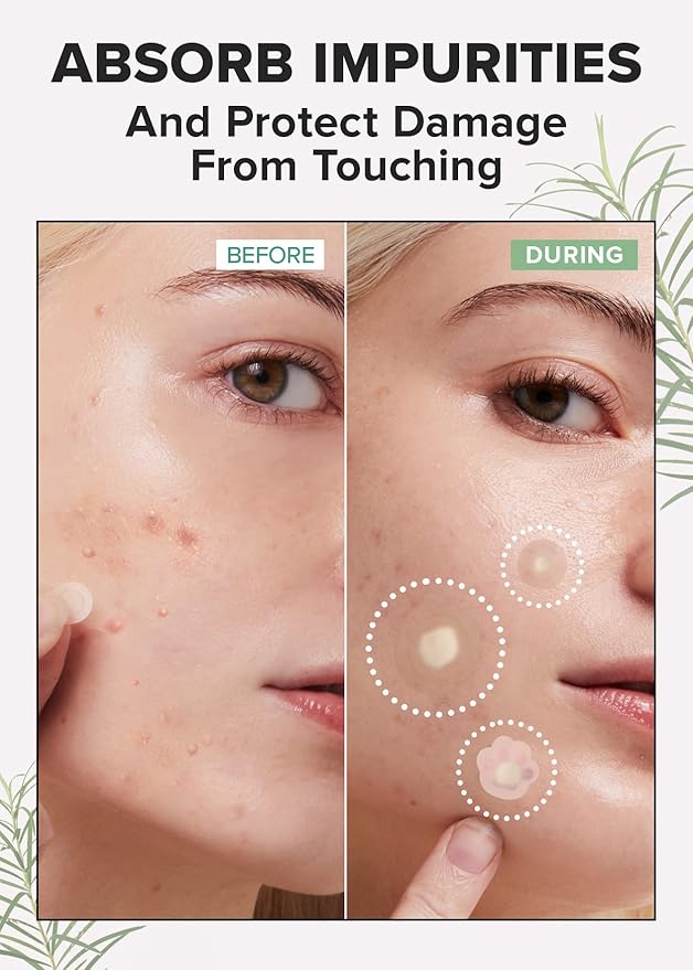 I DEW CARE Facial Skin Care Set - Meet Your Patch & Proper Popper & Headband | Cute Pimple Patches, Clear and Soothe Irritation, Blemish Treatment for Face, Trouble Spot Remover