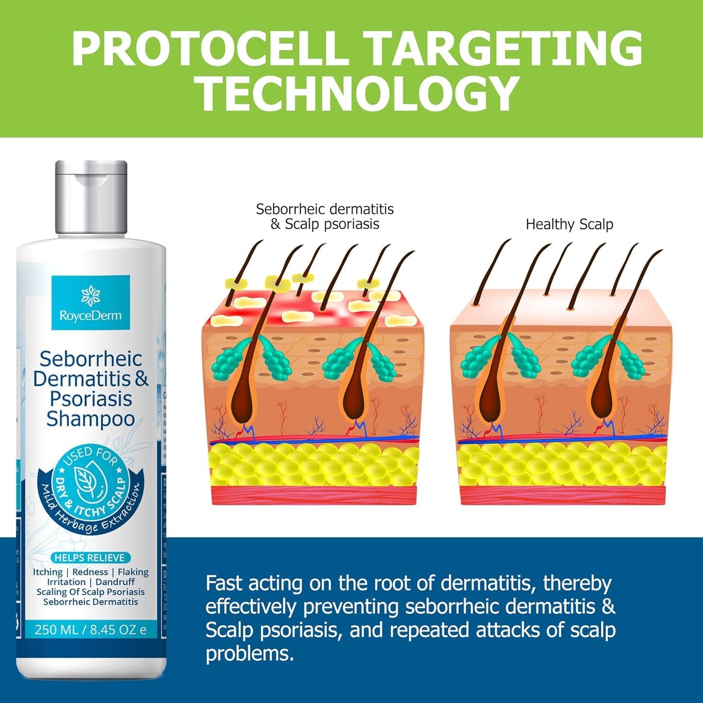 Roycederm Psoriasis Shampoo, Seborrheic Dermatitis Shampoo, Folliculitis Shampoo, Dandruff Shampoo, Scalp Psoriasis & Seborrheic Dermatitis Treatment, Dry Itchy Scalp Treatment