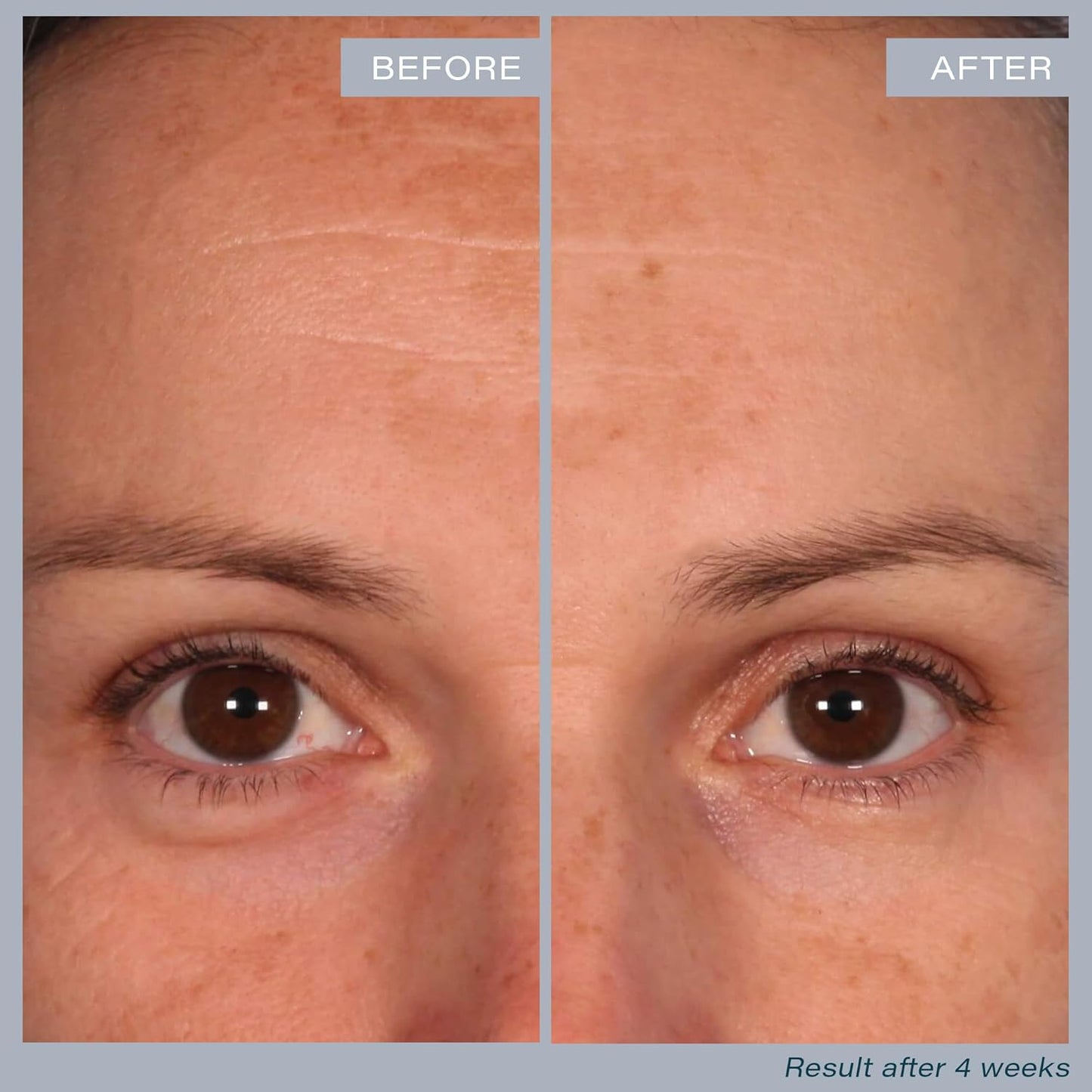 SKINN Multi-Acid Resurfacing Pads, with Glycolic, Lactic & Salicylic Acid, 60 Pads - Witch Hazel Chemical Peel for Face, Neck & Decollete Exfoliates, Brightens & Tones Skin, for Fine Lines & Wrinkles