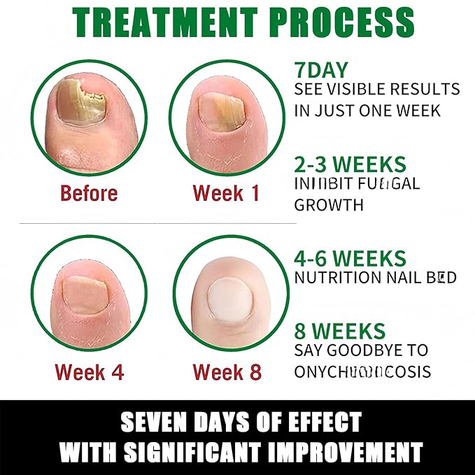 2Pcs Ginger Nail Growth and Strengthener-Nail Growth Serum-30ML Each Natural Nail Strengthener for Damaged Nails-Ginger Nail Treatment