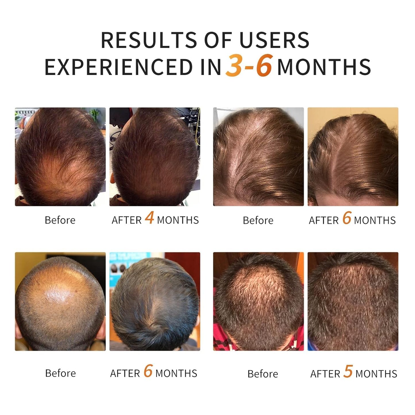 Irradiation Aesthetic Device Professional Hair Growth Laser Cap - FDA Cleared Low Level Laser Therapy Hair Regrowth for Men & Women, Hair Loss Treatment for Androgenetic Alopecia