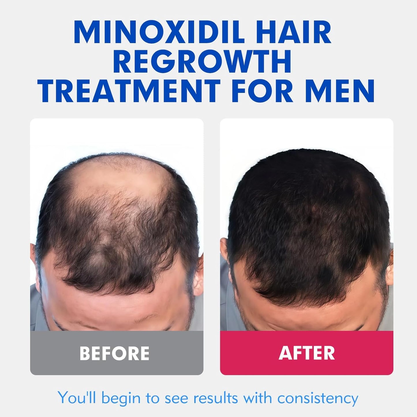 5% Minoxidil for Men Hair Regrowth Treatment, Extra Strength Topical Solution for Thinning Hair & Balding, Beard Growth Enhancer, Non-Greasy Fast-Absorbing Formula, 4-Pack (240ml) 4-Month Supply