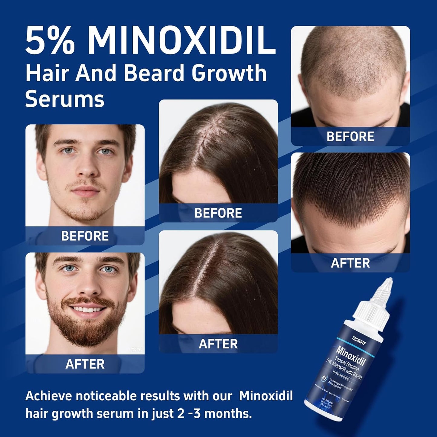 5% Minoxidil with Biotin, Hair Growth Treatment, Minoxidil Hair and Beard Growth Oil, Minoxidil for Men and Women, Supports Thicker and Fuller Hair & Beard (4 fl oz, 2 Month Supply)