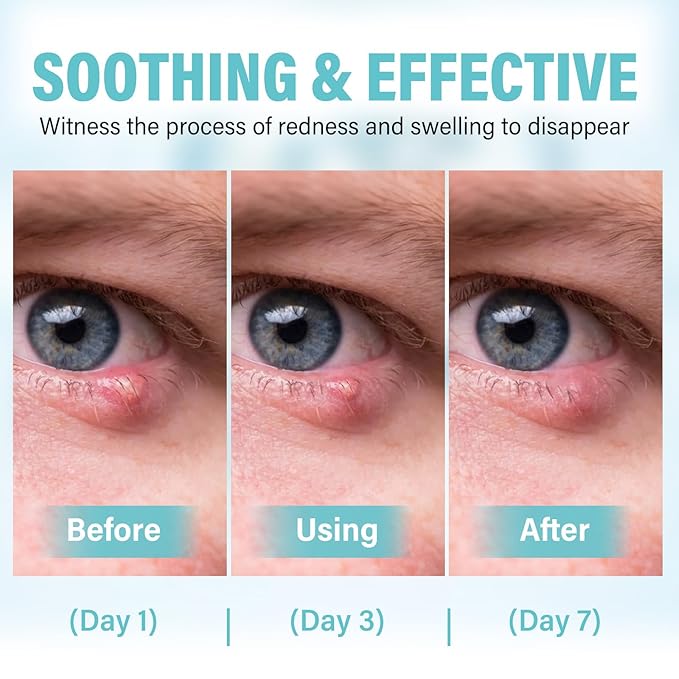 Stye Eye Treatment, Effective Stye Eye Relief Drop, for S_tyes Blepharitis and Chalazion Treatment, Regain Healthier Ey_e Skin