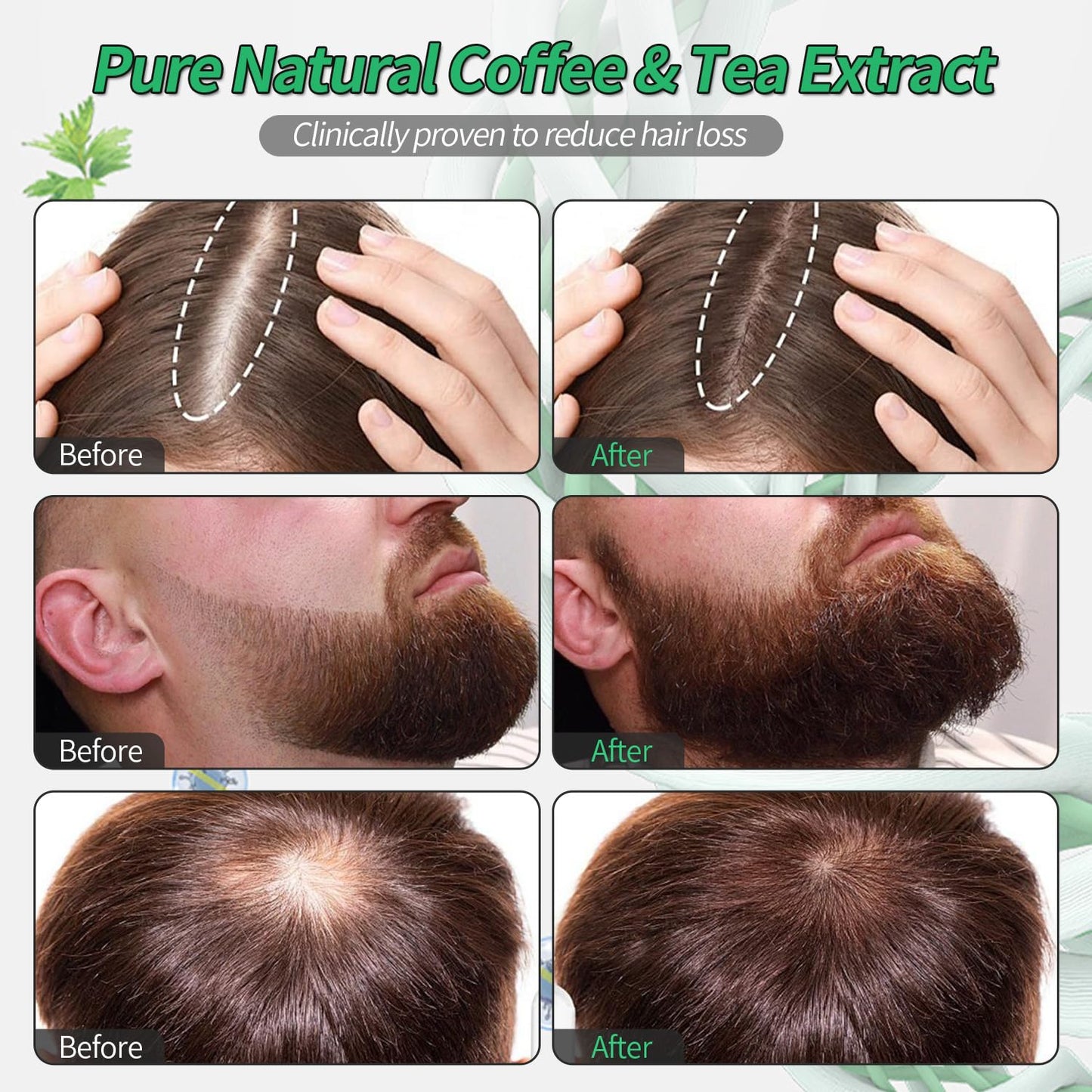 Hair Growth Serum, Orrenaturals Hair Revival Ampoule 3% Rosemary Hair Growth Serum Roll On 30ml Scalpy Hair Growth Oil for Hair Loss&Thinning