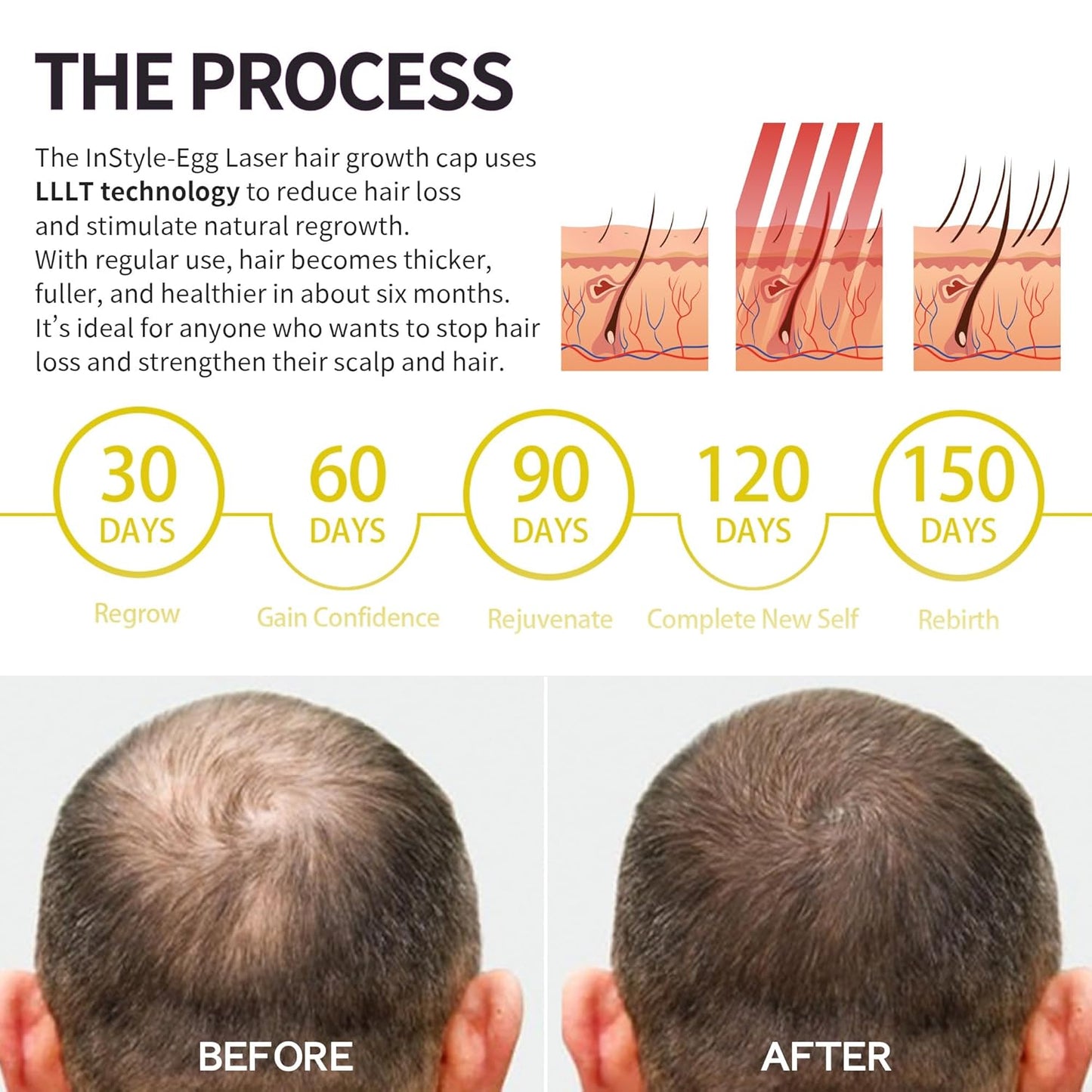 Instyle Egg 280 Cap for Hair Regrowth, Low Level Laser Therapy System for Hair Loss and Regrow Thinning Hair for Men/Women