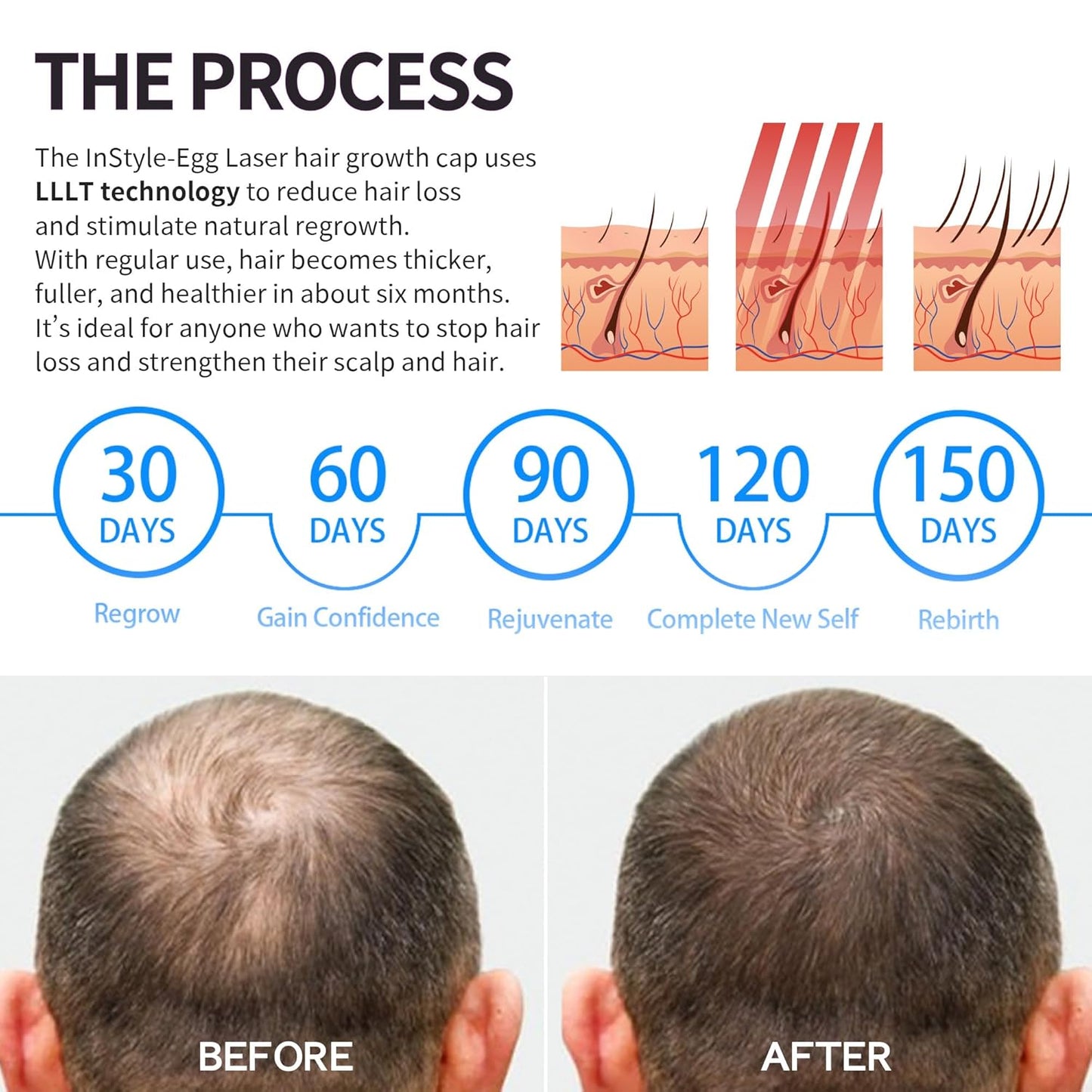 Instyle Egg Laser Cap 272 for Hair Growth, Hair Regrowth System for Men/Women, Scalp Treatment to Stop Hair Loss and Regrows Thinning Hair, laser hair regrowth