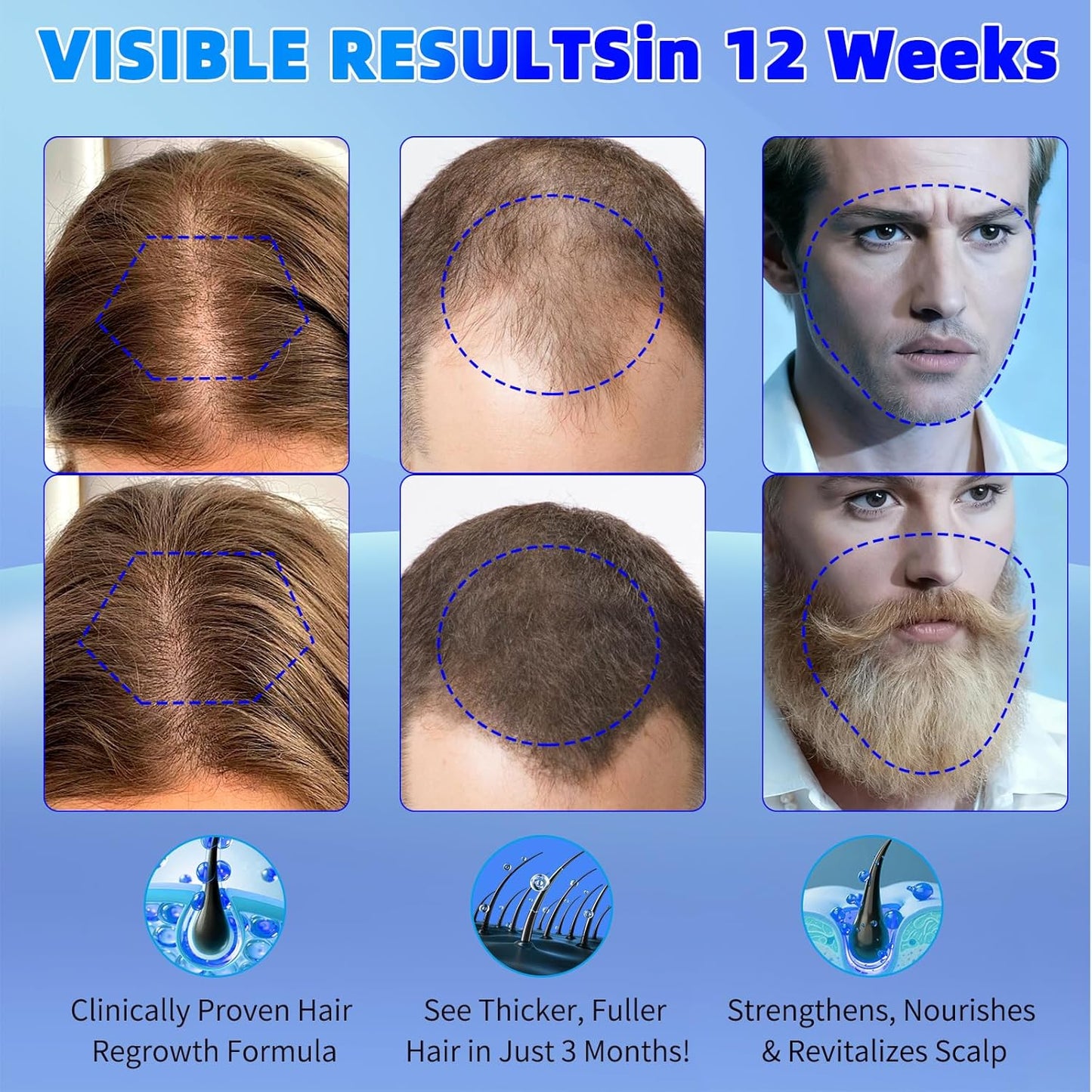 Minoxidil for Men and Women Hair Growth: 5% Minoxidil Spray Hair Regrowth Treatment Serum Stop Hair Thinning and Hair Loss For Stronger Thicker Longer Hair