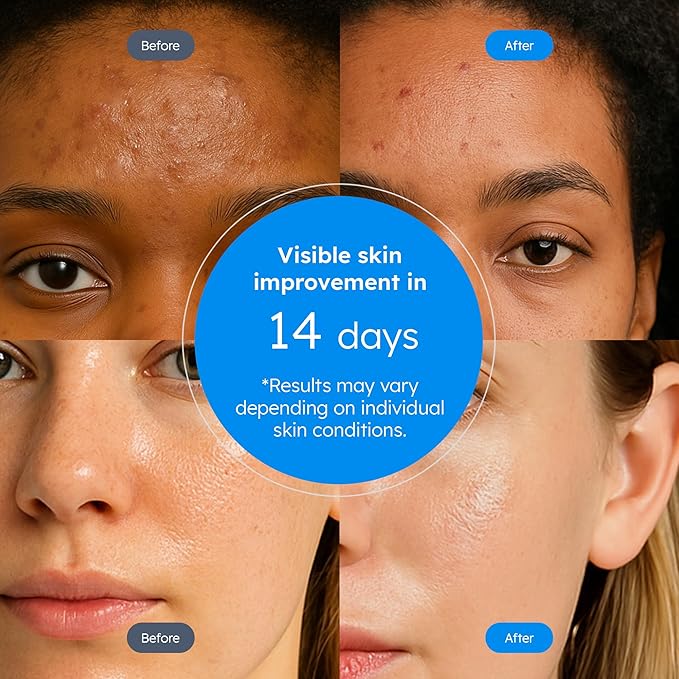 Blissberry 0.1% Salicylic Acid Acne Serum - Hydrating Serum Soothing Moisturizer, Salicylic Acid for Blackheads & Whiteheads Pores, Reduce Excess Oil & Bumpy Texture, 0.5 Fl Oz