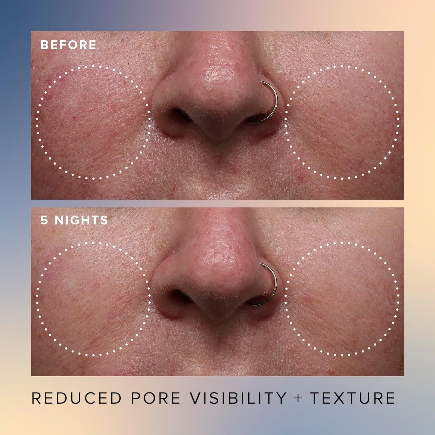 Farmacy Face Exfoliator Serum - Honey Glow 17% AHA + BHA Liquid Exfoliant & Salicylic Acid Serum - Resurfacing Skin Care for Reduced Pores + Texture - Hydrates Skin for an Overall Glow (30ml)