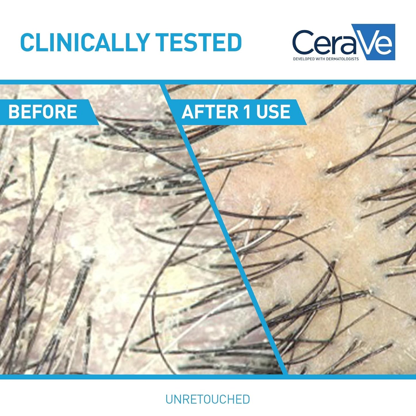 CeraVe Hydrating Anti Dandruff Shampoo and Conditioner Set, Pyrithione Zinc Dandruff Treatment With Ceramides, Hyaluronic Acid & Niacinamide, Helps Elimanate Flakes & Reduce Itchy Scalp