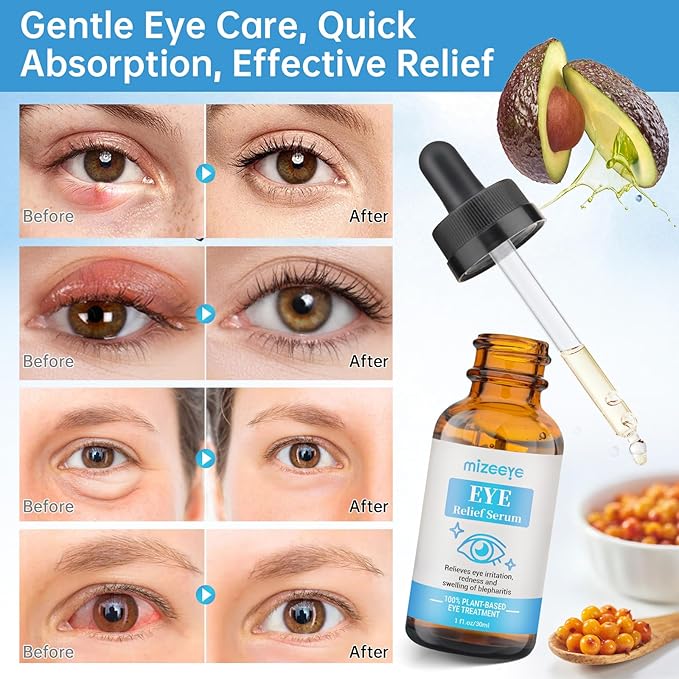 Eye Serum For Chalazion & Blepharitis Treatment, 2 PCS Chalazion Remover For Eyelid Treatment, Eyelid Serum With Avocado Oil, Sea Buckthorn Oil & Caffeine, Relieve Puffiness and Eye Fatigue