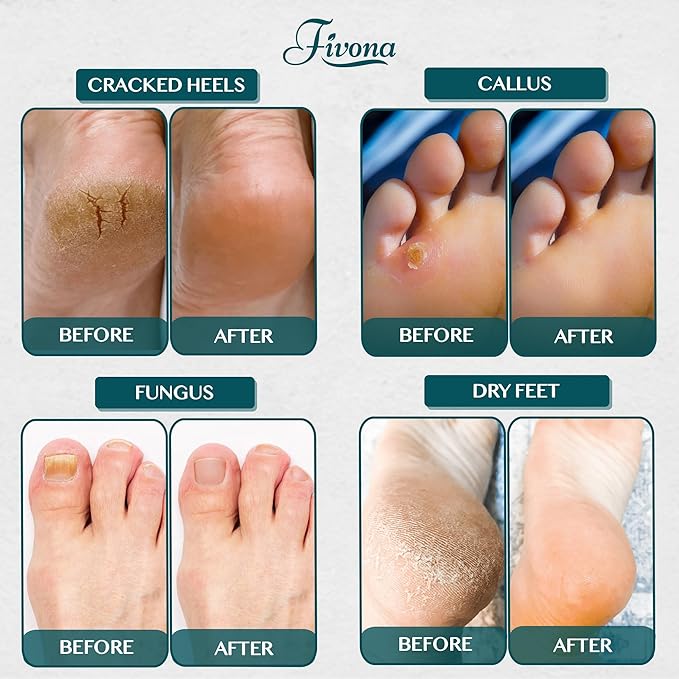 Foot Soak Epsom Salt with Tea Tree Oil 2 LB - Epsom Salt with Essential Oils for Healthy Toenails, Soothing Relief, Callus Softening - Pedicure Therapy for Soft, Rejuvenated Feet