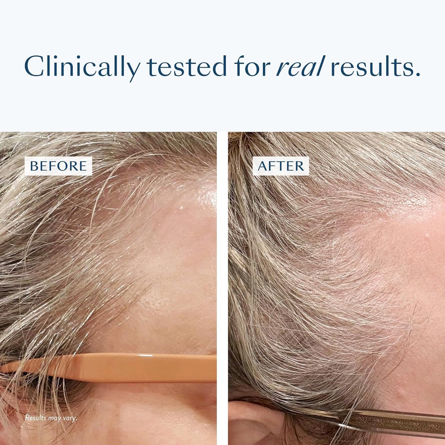 eSalon Thinning Hair Bundle, Root Touch Up + Brow Powder (Dard Blonde), 2% Minoxidil Hair Regrowth Treatment, Densifying Scalp Serum with Procapil + Redensyl