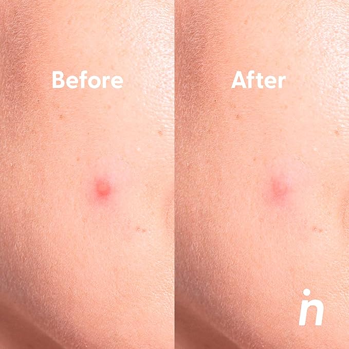 My Way Out Patches with Micro Hydrocolloid Capsules for Blind Granites -Waterproof Zit Stickers for All Skin Types