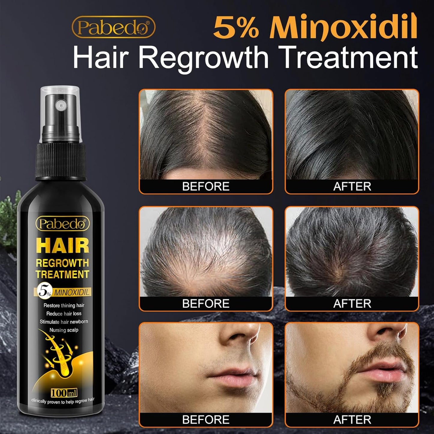 5% Minoxidil for Men and Women Hair Growth Serum - Castor Oil & Biotin Hair Growth Spray Hair Regrowth Treatment for Scalp Hair Loss Hair Thinning For Thicker Longer Fuller Healthier Hair 100Ml