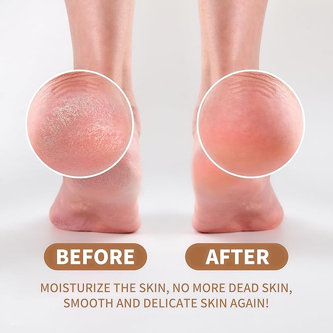 Yaya Callus Remover for Feet - Extra Strength - Vitamin E + Moisturizing Effect - Foot Scrubber File and 5 Pink Latex Gloves - Callus Remover Gel 8OZ - Foot Spa Kit