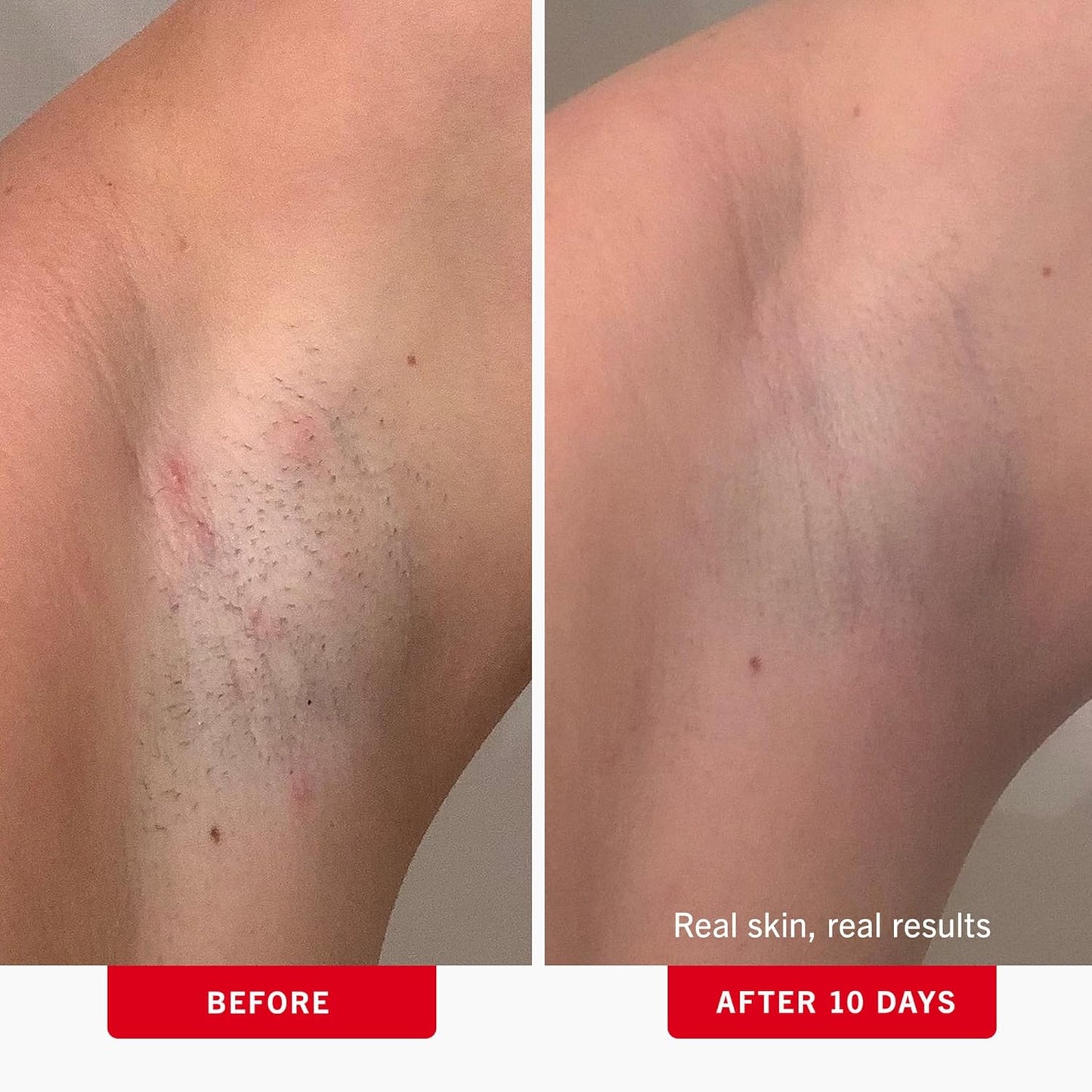 First Aid Beauty - Ingrown Hair Pads with BHA + AHA - Aftershave Treatment Pads Help Men & Women Prevent Razor Bumps, Exfoliate Underarms & Bikini Area, Compostable for Daily Use - 3ct, 84 Pads Total