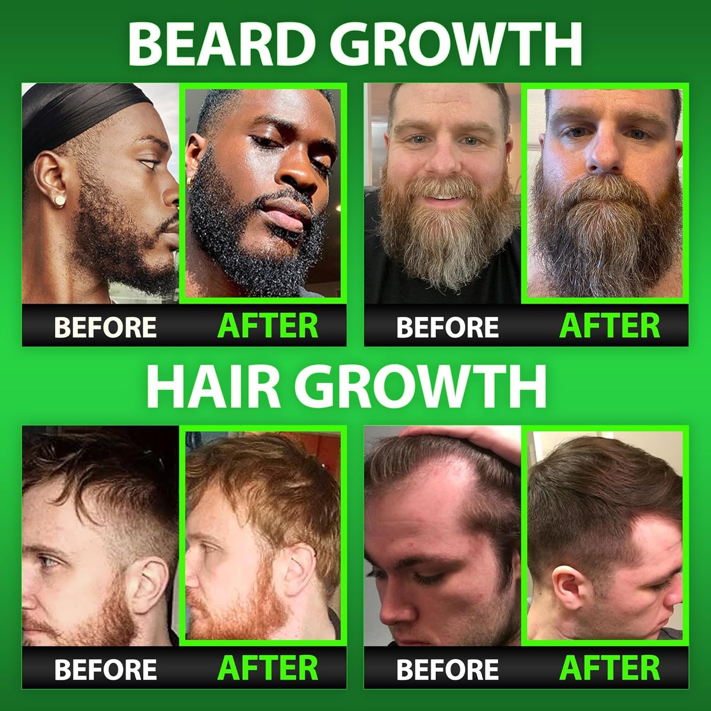 GROW Beard Oil Serum + Biotin Beard Growth Gummies – Beard Growth Kit for Men with 620,000mcg Biotin, Collagen, MSM & Keratin – Thickens Beard, Fills Patches & Supports Hair Growth