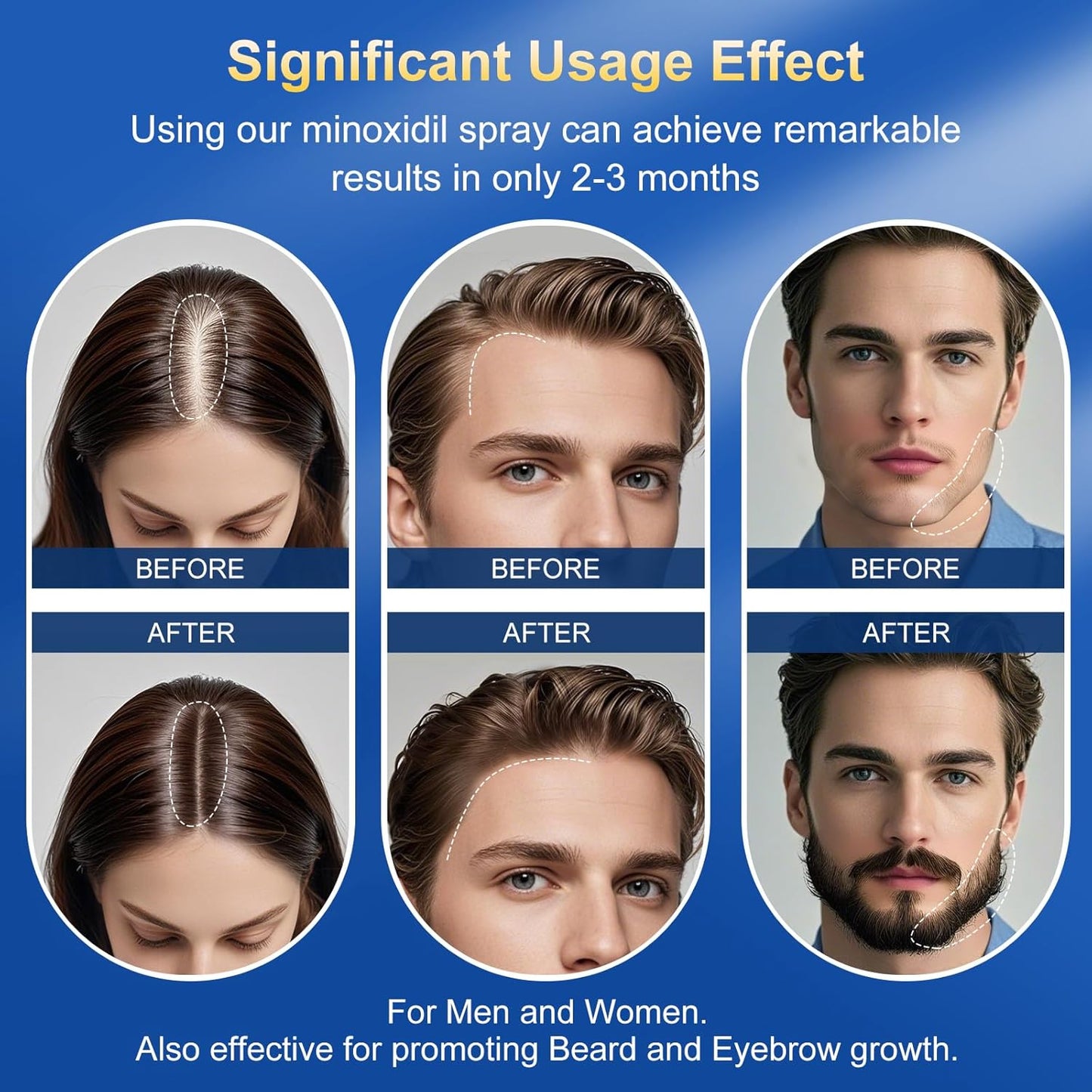 5% Minoxidil Spray for men & Women-5 pack，Infused with Biotin, Hair Regrowth for Men，Hair Loss Treatments for Women，Supports Thicker，Fuller Hair & Beard (17.5oz, 8 - Month Supply)