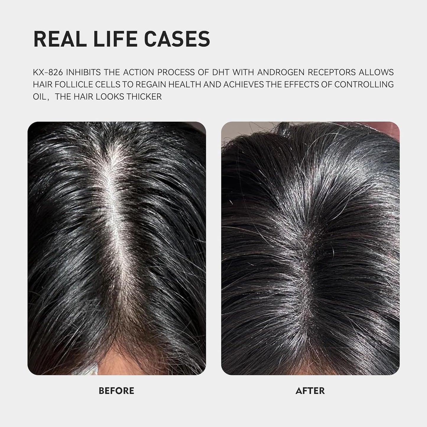 KINTOR 0.5% 0.9% KX-826 Hair Regrowth Spray,Reduce Fuller-looking Healthier Hair,Oil Control, Hair Care Products Group for Men&Women,3 Bottles, Basic,Plant-Based,Pro