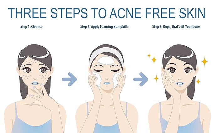 Acne Treatment For Sensitive Skin - 80% of Acne Gone in 4 Weeks. Pimple Cream Stops Face Acne and Teen Acne Without Drying or Irritating Skin. Zit Cream, Face Toner for Pimple Prone Skin.