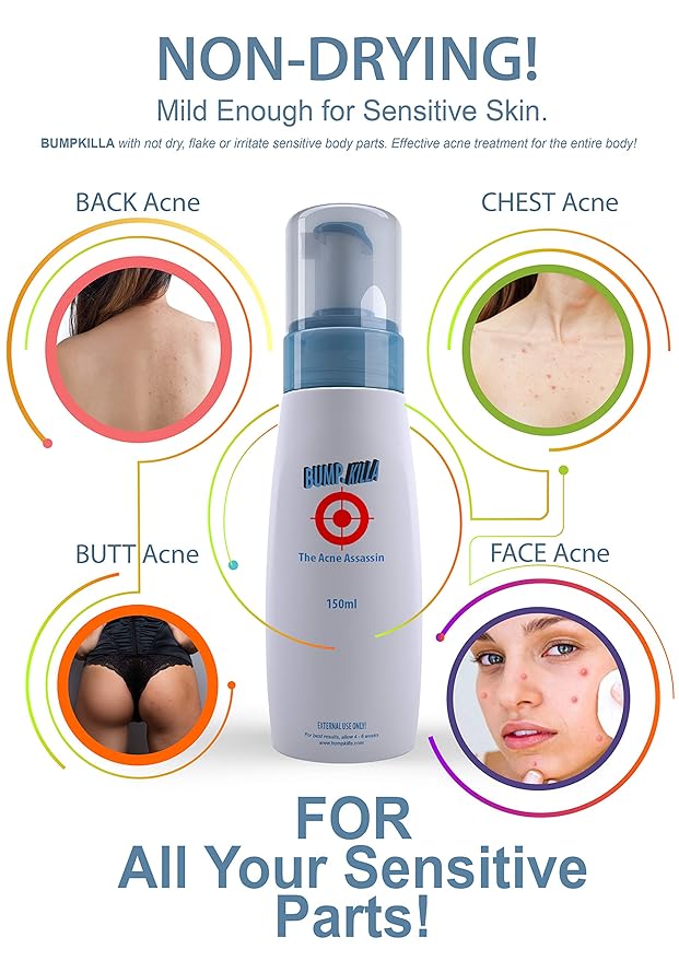 Acne Treatment For Sensitive Skin - 80% of Acne Gone in 4 Weeks. Pimple Cream Stops Face Acne and Teen Acne Without Drying or Irritating Skin. Zit Cream, Face Toner for Pimple Prone Skin.