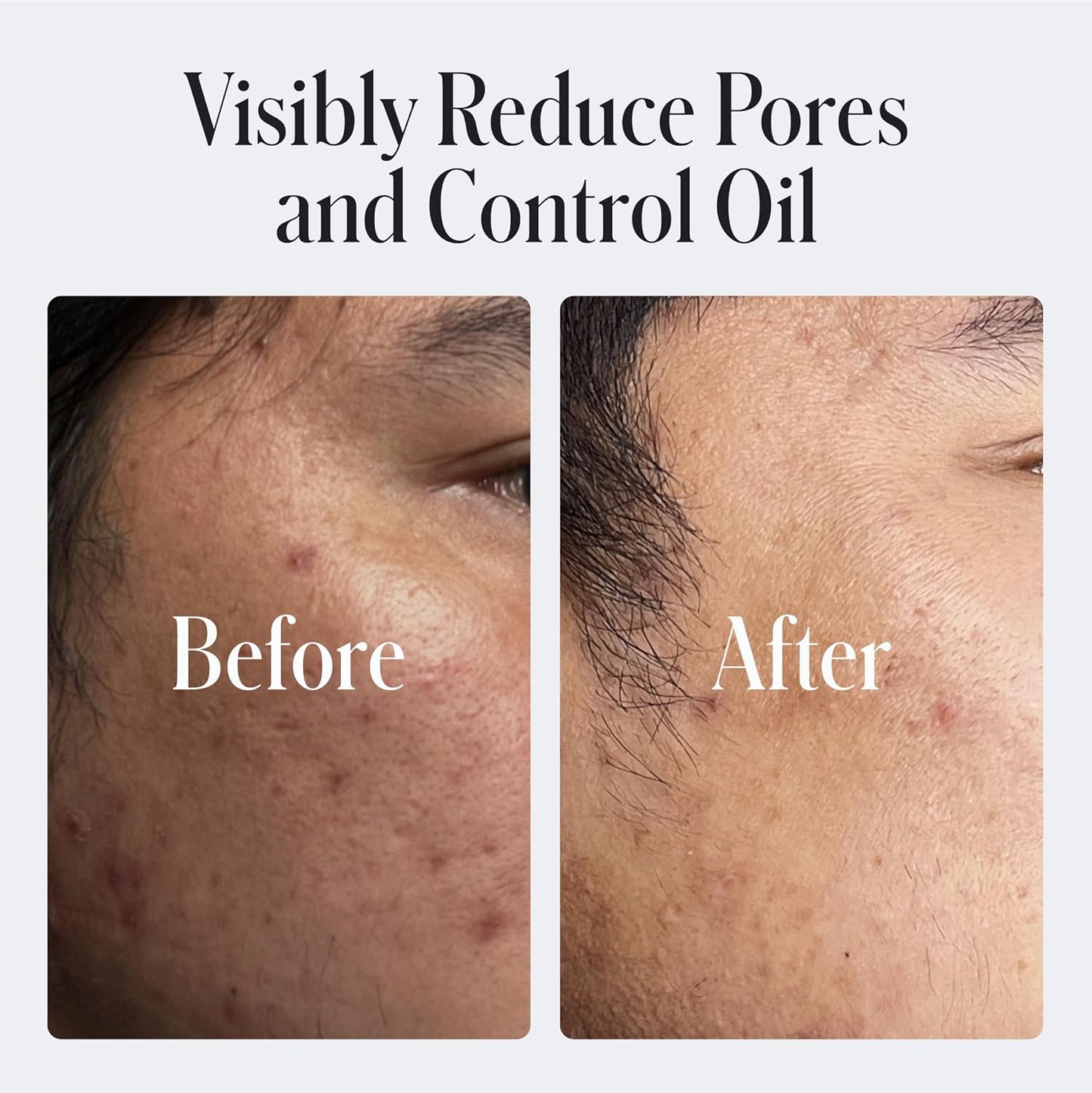 Geologie 2% Salicylic Acid Unscented Face Wash | Fragrance-Free Facial Cleanser for Men & Women | Acne & Oil Control | Non-irritating, Deep Cleansing & BHA Exfoliating Face Wash | 2-Pack