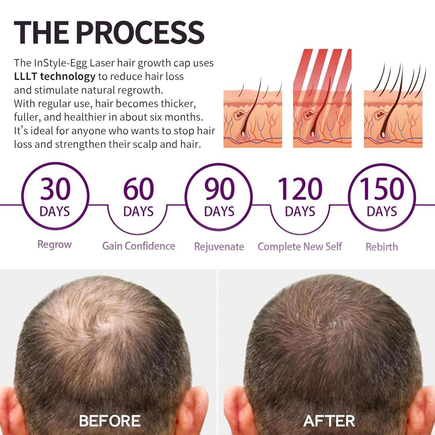 Instyle Egg Laser Hair Growth Cap – 80 Medical-Grade Diodes, FDA Cleared LLLT Red Light Therapy for Hair Regrowth & Thicker Hair, Hair Loss Treatment for Men & Women