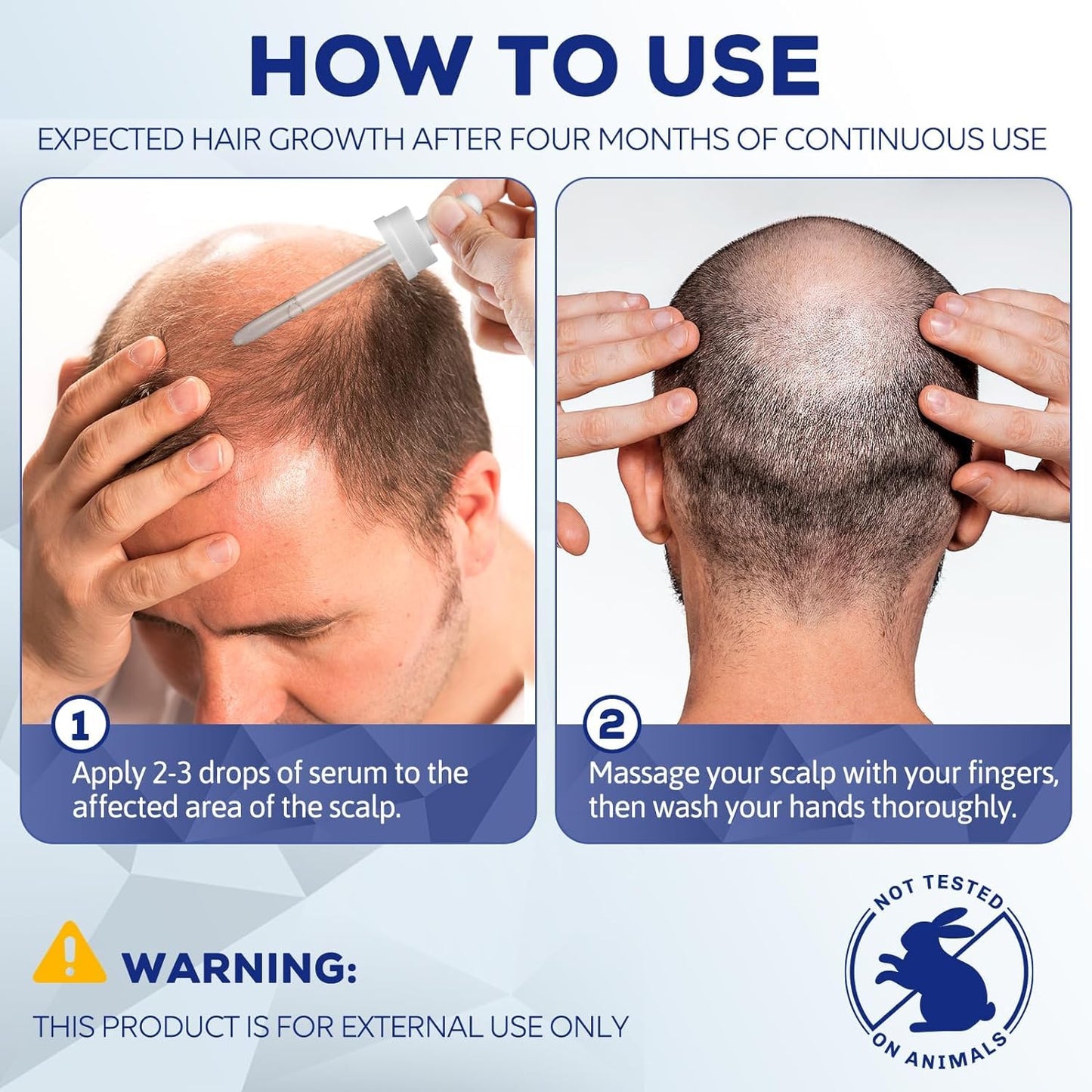 5% Minoxidil for Men, Hair Regrowth Treatment for Thinning Hair and Hair Loss, Topical Solution - 1 Months Supply - Dermatologist recommended (Pack of 1)