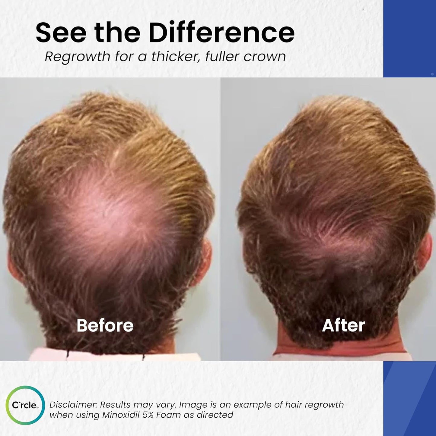 Minoxidil for Men Foam 5% - Unscented 3 Month Supply - Helps Restore Vertex Hair Loss & Thinning - 5% Minoxidil Foam For Men - Extra Strength Supports Hair Regrowth