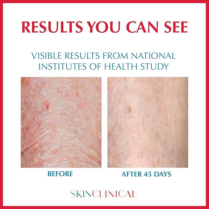 Daily Restore Hydrating and Moisturizing Body Lotion For Very Dry Skin, Psoriasis and Eczema Aftercare, Nourishes Skin with SBD-4 Patented Ingredient, Unscented Body and Face Lotion, 6 oz