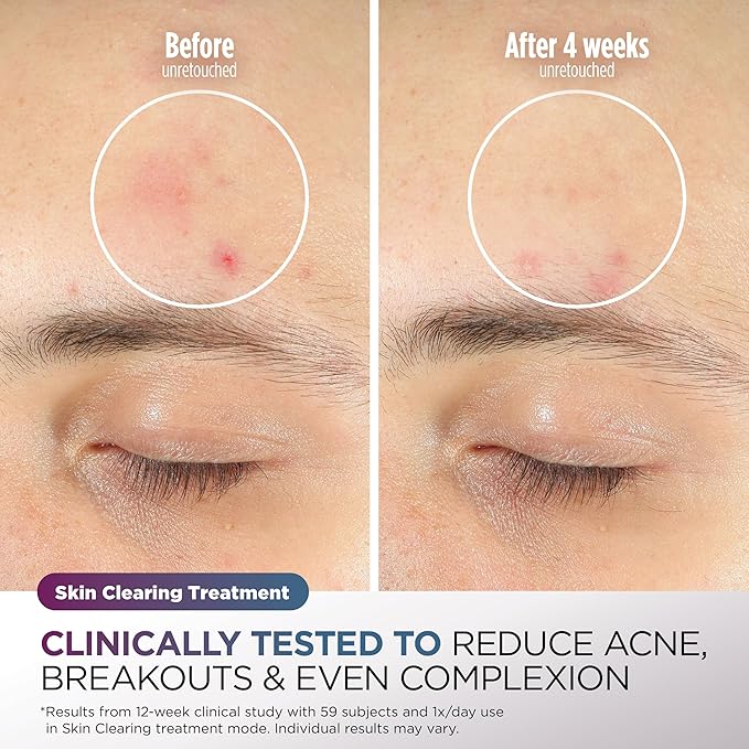 Shark CryoGlow LED Face Mask (FSA/HSA Eligible*) with Under-Eye Cooling, Anti-Ageing & Blemish Repair, Red & Blue LED, Infrared Light Therapy, USB-C, Remote Control, Storage Bag, Lilac Chill, FW312PL