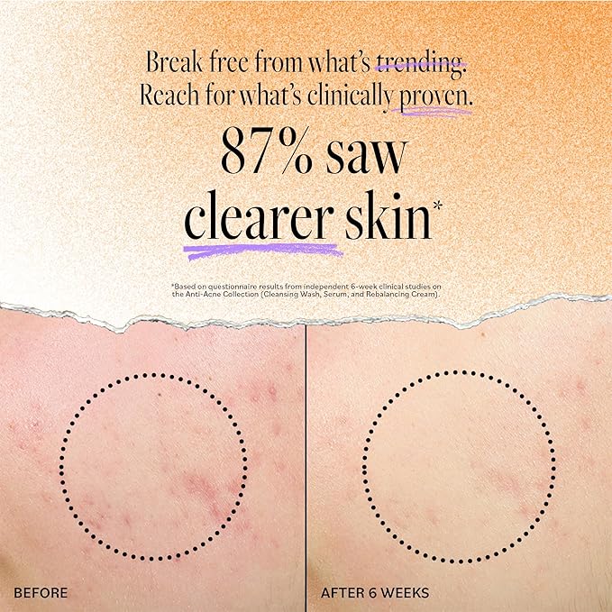 DERMA E Acne Spot Treatment, Acne Blemish Control Treatment Serum, 2 Fl Oz, Clinically Studied to Help Fight Blackheads, Breakouts and Cystic Acne for Clearer Looking Skin