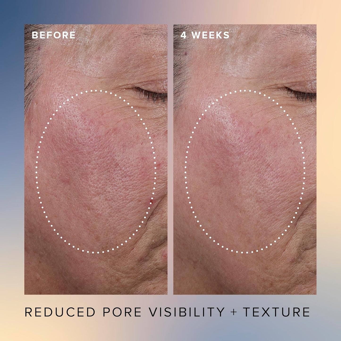 Farmacy Face Exfoliator Serum - Honey Glow 17% AHA + BHA Liquid Exfoliant & Salicylic Acid Serum - Resurfacing Skin Care for Reduced Pores + Texture - Hydrates Skin for an Overall Glow (30ml)