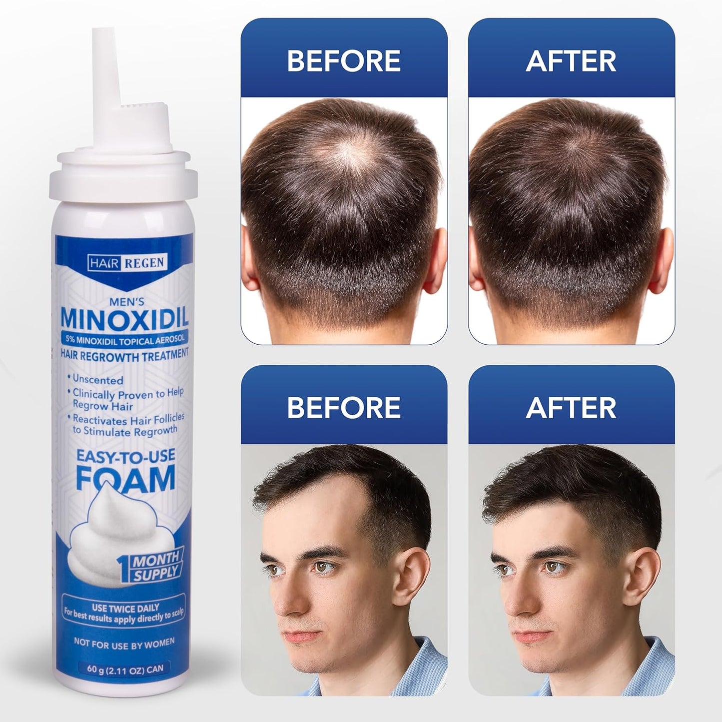 5% Minoxidil Foam for Men 1 Pack - Men's 5 Percent Hair Growth Treatment - Topical Foaming Minoxidil for Men 1 Month Supply - Great for Hair Regrowth and Reduce Hair Loss